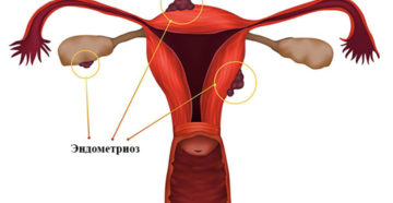 Перименопауза, эндометриоз Перименопауза, эндометриоз