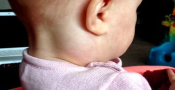 Цитомегаловирус и лимфоузлы