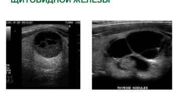 Образование в щитовидной железе