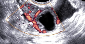 Образование в яичнике