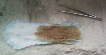 После осмотра шейки коричневые выделения