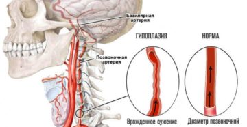 Грыжа и гипоплазия позвоночной артерии