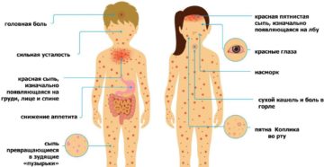 Сильные головные боли при ветрянке