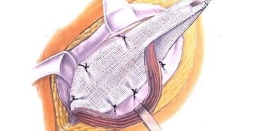 Послеоперационный период после лечения паховой грыжи по Лихтенштейну