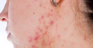 Задержка, сильные высыпания прыщей Задержка, сильные высыпания прыщей