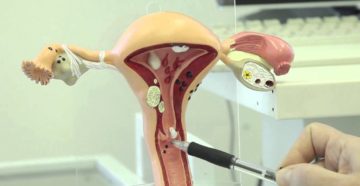 Прижигание кист на шейке матки Прижигание кист на шейке матки