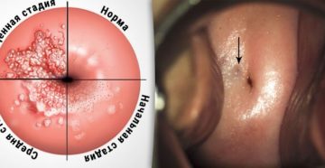 Что должно насторожить при прижигания очага эндометриоза и эрозии