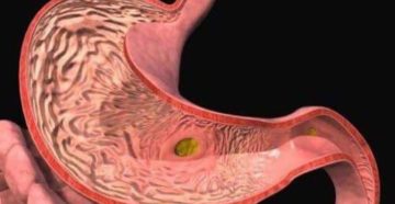 Тахикардия на фоне гастрита