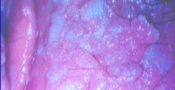 Белая слизистая вульвы