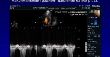 Трикуспидальная регургитация 2 ст. У ребёнка 9 лет