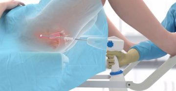 Температура после прижигания эрозии