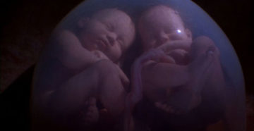 Двойня, состояние плода