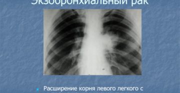 Корни легких с полицикличными контурами
