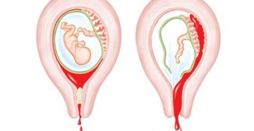 Тонус матки до начала месячных
