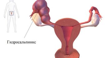 Беременность после гидросальпинкса
