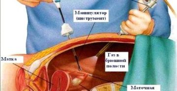 Температура после лапароскопии