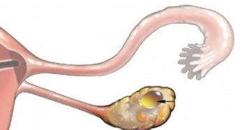Лечение кисты желтого тела марвелоном
