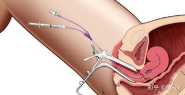 Возможность беременности после удаления матки
