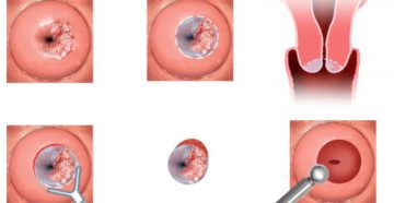 Эктопия и ВМС