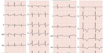 Депрессия сегмента st (2,3, avf). v4-v6
