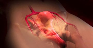 Кровотечение после удаления миомы матки Кровотечение после удаления миомы матки