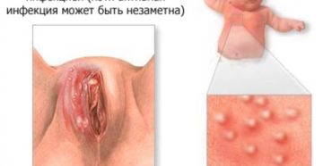 Опухлость рядом с половыми губами Опухлость рядом с половыми губами