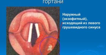 Спавшийся грушевидный синус