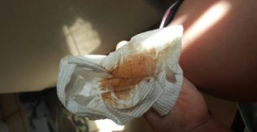 Выделения после Кольпоцида