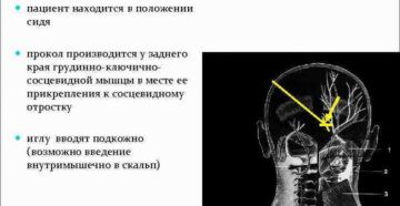 Состав смеси для блокады затылочных нервов