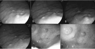 Воспалительные гиперпластические папулы в антральном отделе желудка