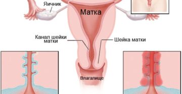 Можно ли забеременеть с эндоцервицитом