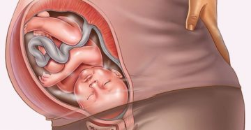 Маловодие при беременности 38 недель