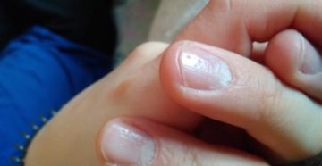 Ямочки на ногтях у ребенка