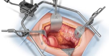 Осложнение после лапаротомии