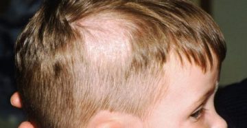 Очаговая алопеция из-за лямблиоза