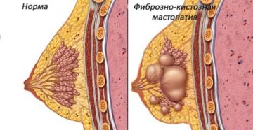 Эко и мастопатия