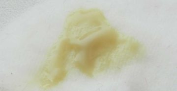 Желтые выделения после солковагина Желтые выделения после солковагина