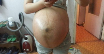 Старший ребенок упал на беременный живот Старший ребенок упал на беременный живот