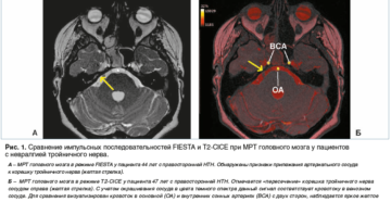 Невралгия тройничного нерва. Необходимость МРТ