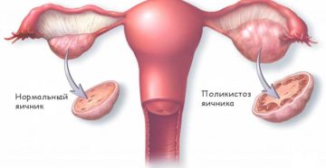 Задержка месячных при поликистозе Задержка месячных при поликистозе