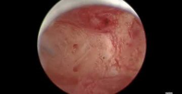 Хронический эндометрит неактивный Хронический эндометрит неактивный