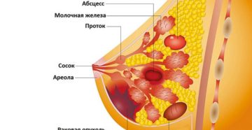 У меня камни в правой груди я не рожала