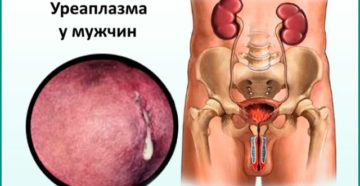 Уреаплазма у мужа отсутствует зато есть у жены