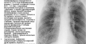 Снижение пневматизации легочной ткани с уплотнением междолевой плевры