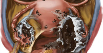 Эндометриоз, прыщи и лишний вес Эндометриоз, прыщи и лишний вес