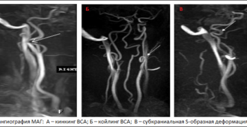 Опасен ли диагноз Кинкинг С1 сегмента левой Вса
