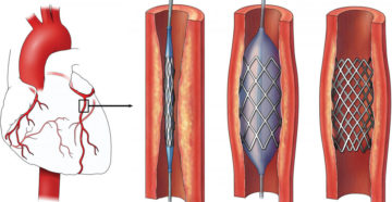 Стенокардия после стентирования