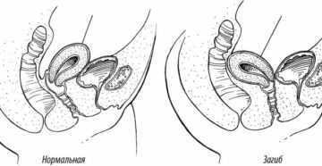Осложнения после родов, загиб матки кзади