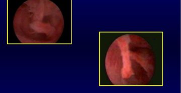 Эндометриальный полип без атипии Эндометриальный полип без атипии