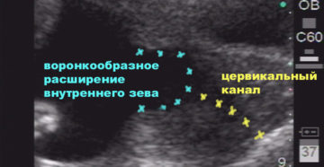 Внутренний зев воронкообразный